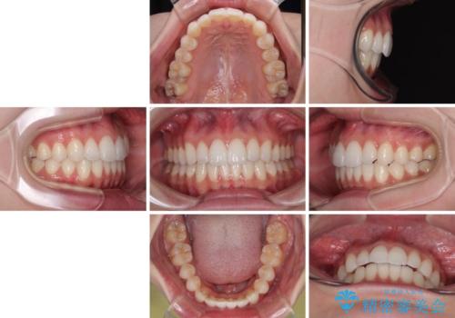 【モニター】前に傾斜した前歯 インビザラインでスッキリとした口元にの治療後
