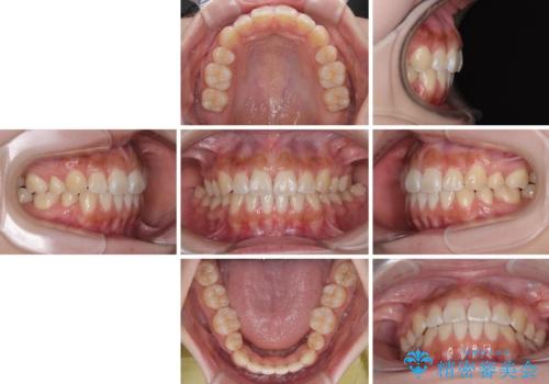 飛べ出ている出っ歯を治したい　目立たない装置での抜歯矯正治療の治療後