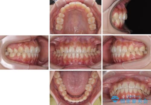 飛び出ている出っ歯を治したい 目立たない装置での抜歯矯正治療の治療後