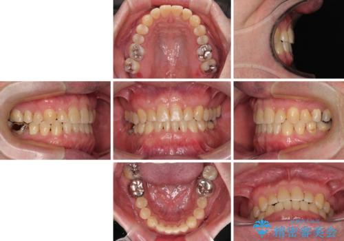 受け口を治す　ワイヤー装置での矯正治療の治療後