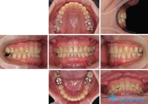 受け口を治す ワイヤー装置での矯正治療の治療後