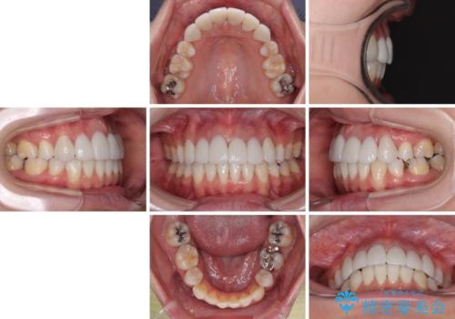 気になる八重歯と変色した前歯 抜歯矯正とセラミッククラウン治療の治療後