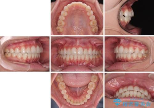 前歯のデコボコを治したい 目立たないワイヤー装置での矯正治療の治療後