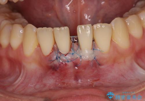 半分以上歯根が見えている　歯肉移植による根面被覆術の治療中