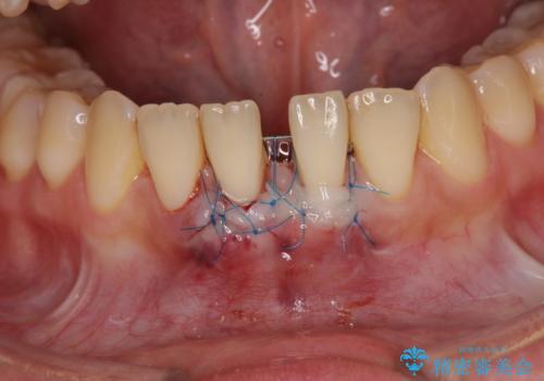 半分以上歯根が見えている 歯肉移植による根面被覆術の治療中
