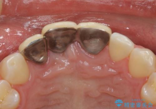 前歯ブリッジのやり変え希望 オールセラミッククラウンの治療前