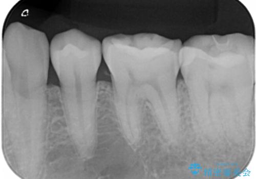 奥歯の保険材料を自費でやり直したいの治療後