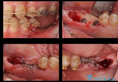 奥歯のインプラントの治療中