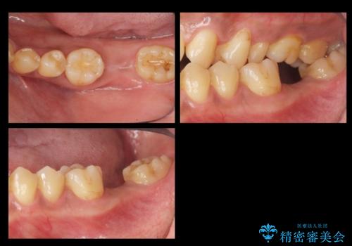 奥歯のインプラントの治療前