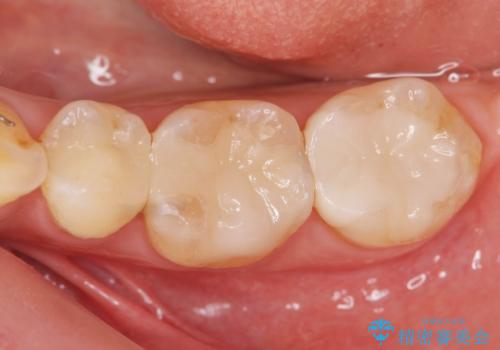 銀歯の周囲が黒く変色 精密セラミック治療の症例 治療後