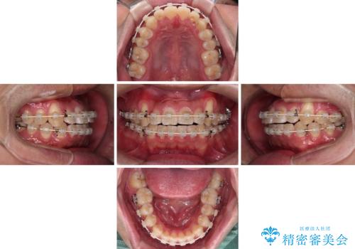 目立つ八重歯を非抜歯矯正で整える 目立たないワイヤー矯正の治療中