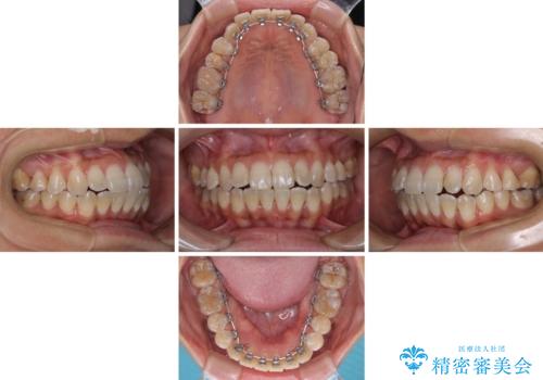 全く目立たないワイヤー矯正 上下裏側矯正の治療中
