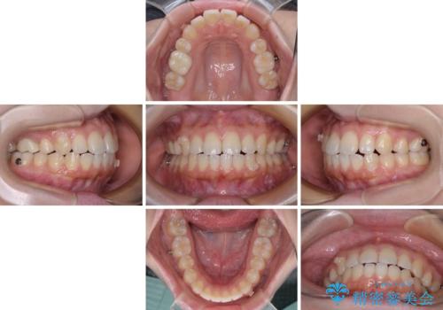 再矯正 開咬に後戻りした歯列をインビザラインで改善の治療中