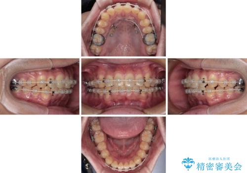 前歯のデコボコを治したい ワイヤー装置での非抜歯矯正の治療中