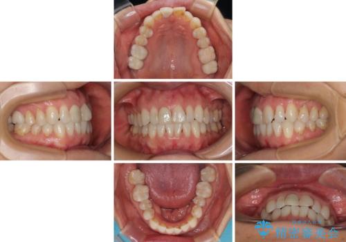 デコボコと銀歯 矯正治療とセラミック治療で綺麗な口元にの治療中