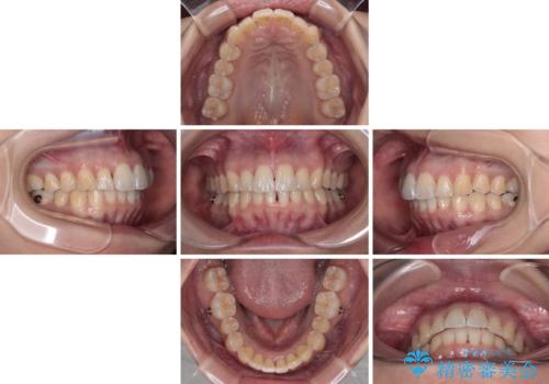 前に飛び出して目立っている前歯を整える　インビザライン矯正治療の治療中