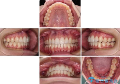 【モニター】前に傾斜した前歯 インビザラインでスッキリとした口元にの治療中