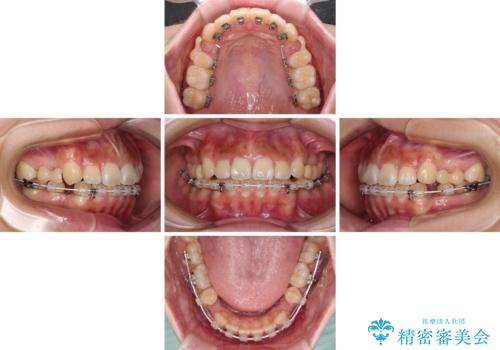 飛べ出ている出っ歯を治したい　目立たない装置での抜歯矯正治療の治療中