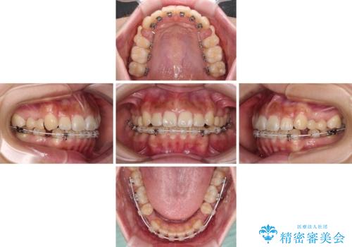 飛び出ている出っ歯を治したい 目立たない装置での抜歯矯正治療の治療中