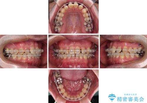 受け口を治す　ワイヤー装置での矯正治療の治療中