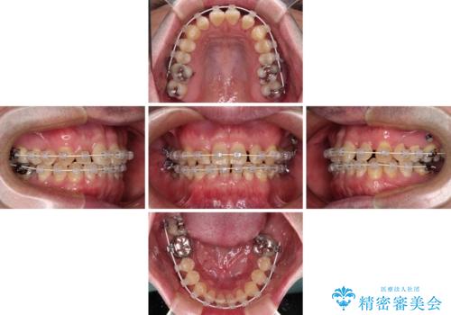 受け口を治す ワイヤー装置での矯正治療の治療中