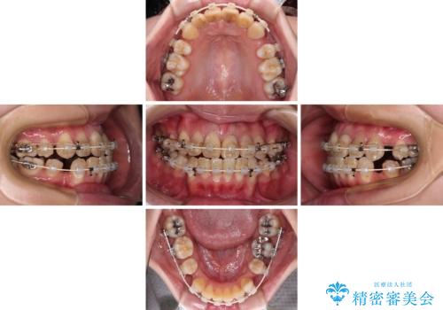 気になる八重歯と変色した前歯　抜歯矯正とセラミッククラウン治療の治療中