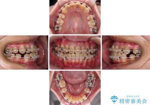 気になる八重歯と変色した前歯 抜歯矯正とセラミッククラウン治療の治療中