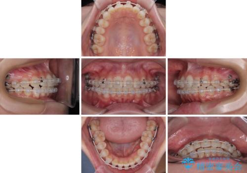 前歯のデコボコを治したい 目立たないワイヤー装置での矯正治療の治療中