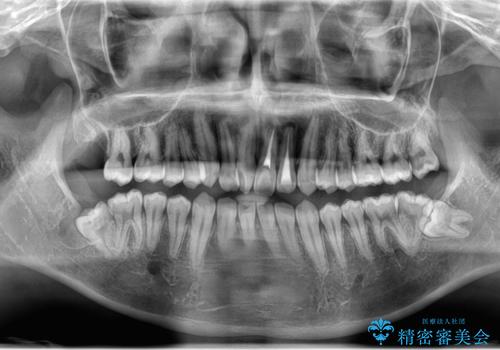 右下親知らず抜きたい。の治療後