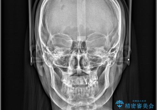 【ワイヤー矯正】八重歯 歯のでこぼこを治したい!の治療後