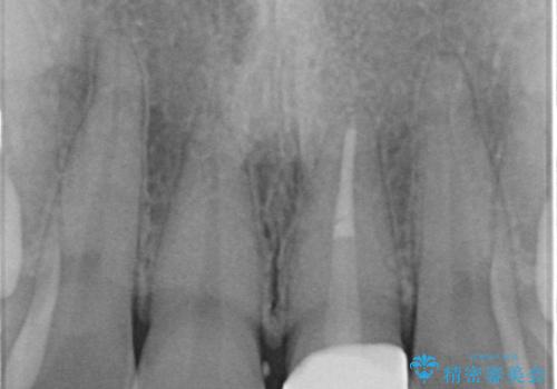 前歯の変色とガタつき ジルコニアクラウンでの修復の治療後