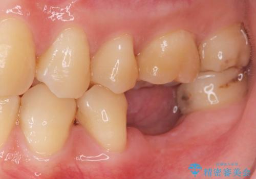 大臼歯の欠損 インプラント治療の治療前