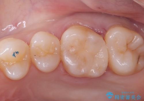 【セラミックインレー】歯に穴が空いているの治療後