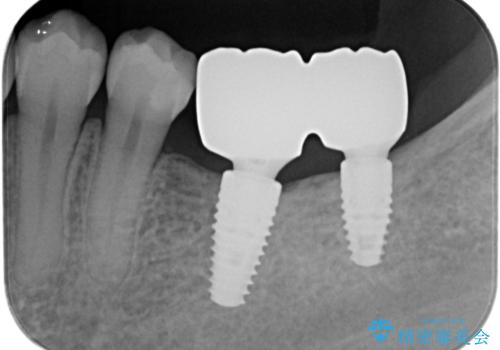 奥歯のインプラントの治療後