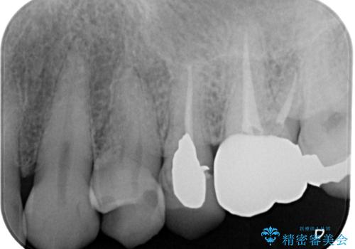 銀歯が取れたのでやり替えたい　セラミックインレー修復の治療前