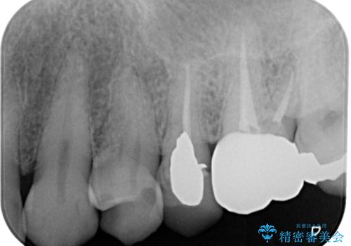 銀歯が取れたのでやり替えたい セラミックインレー修復の治療前