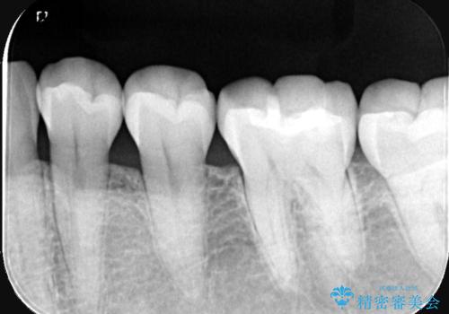 【セラミックインレー】噛む面が青白い気がするの治療後