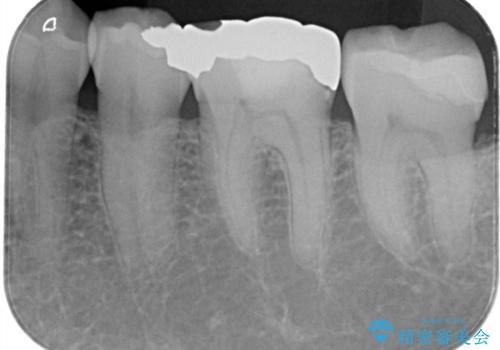 【セラミックインレー・フルジルコニアクラウン】2本の銀歯の下が虫歯にの治療前