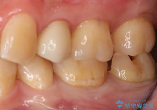 奥歯の保険材料を自費でやり直したいの治療中
