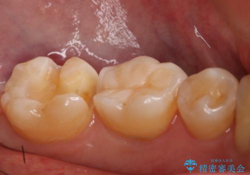 奥歯の保険材料を自費でやり直したいの治療中