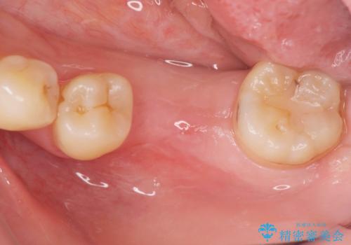 大臼歯の欠損 インプラント治療の治療前