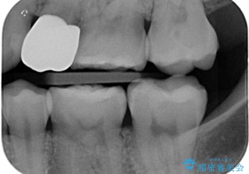 奥歯の保険材料を自費でやり直したいの治療前