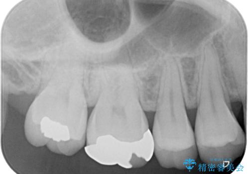 銀歯をやり替えたい フルジルコニアクラウン・ゴールドインレー修復の治療前