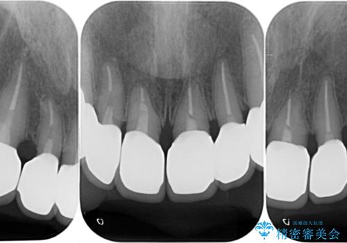 [ 歯ぐきから出血をする ]　歯周外科を伴うセラミックやりかえ治療の治療後