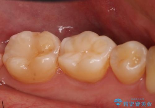 奥歯の保険材料を自費でやり直したいの治療前