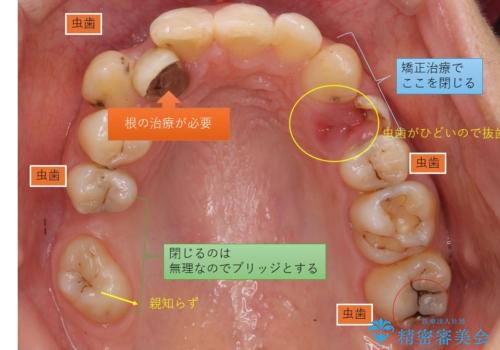 あきらめないで!!虫歯でボロボロでも大丈夫! 非抜歯矯正と虫歯、インプラント治療で見違える歯並びに。