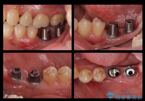 奥歯のインプラントの治療中