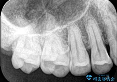 【セラミックインレー】海外に行く前に虫歯治療してほしいの治療前