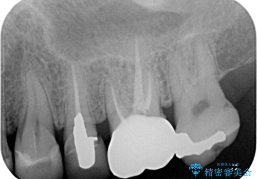 銀歯が取れたのでやり替えたい セラミックインレー修復の治療後