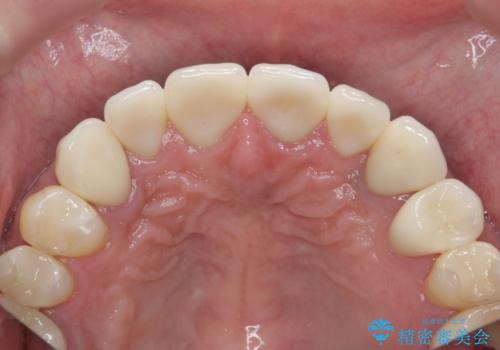 複数箇所コンポジット充填された前歯をセラミック治療の治療後